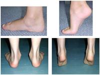 ناهنجاری کف پای صاف و روش های اندازه گیری آن در دانش آموزان