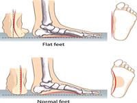 ناهنجاری کف پای صاف و روش های اندازه گیری آن در دانش آموزان