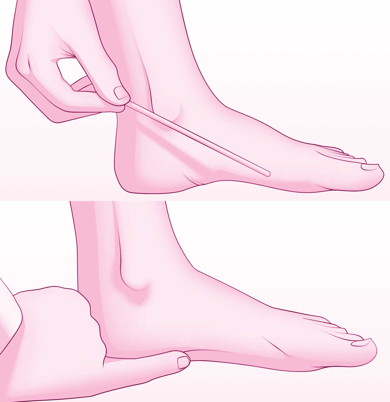 ناهنجاری کف پای صاف