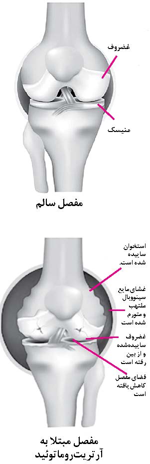 مفصل مبتلا به آرتریت روماتوئید